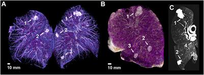 Human Cadaveric Artificial Lung Tumor-Mimic Training Model